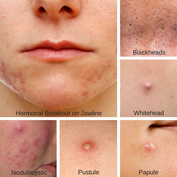 these-are-the-best-treatments-for-every-type-of-acne